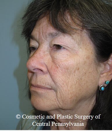 Blepharoplasty Before
