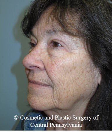 Blepharoplasty After