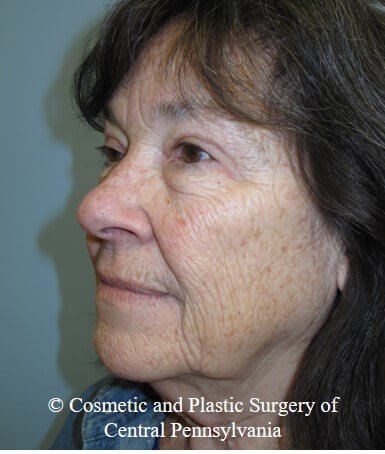 Blepharoplasty After