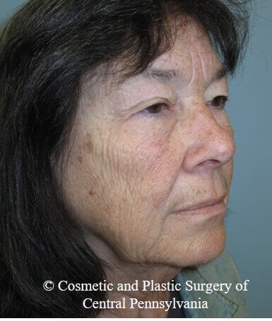Blepharoplasty Before