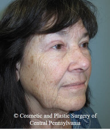Blepharoplasty After