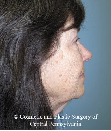 Blepharoplasty After
