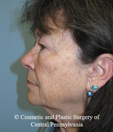 Blepharoplasty Before
