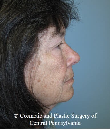 Blepharoplasty Before