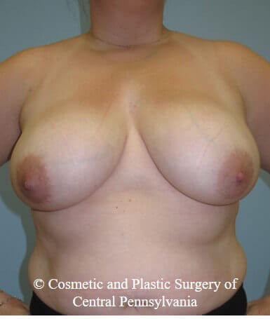 Breast Reduction Before