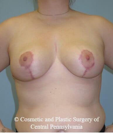 Breast Reduction After