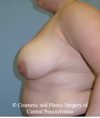 Breast Reduction Before