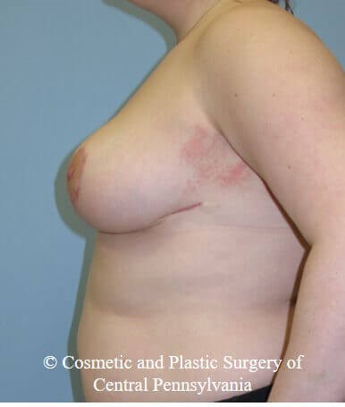 Breast Reduction After