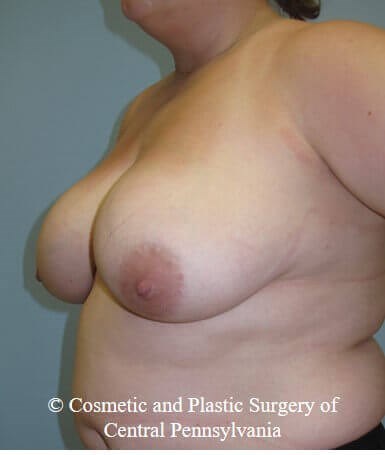 Breast Reduction Before