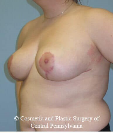 Breast Reduction After