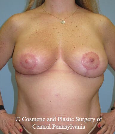 Breast Lift - mastopexy After