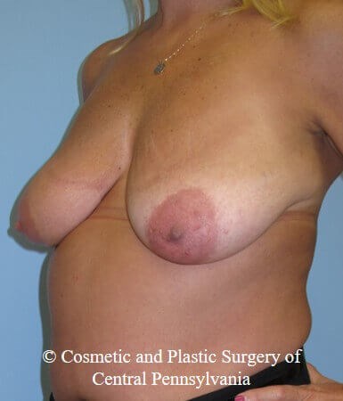 Breast Lift - mastopexy Before