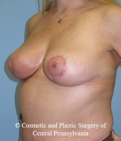 Breast Lift - mastopexy After