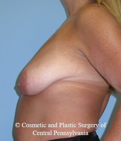 Breast Lift - mastopexy Before