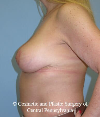 Breast Lift - mastopexy After