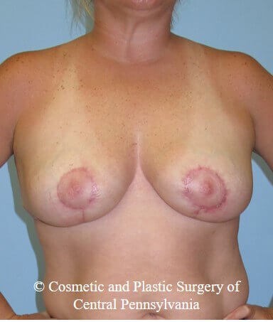 Breast Reduction After