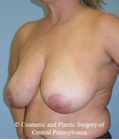 Breast Reduction Before