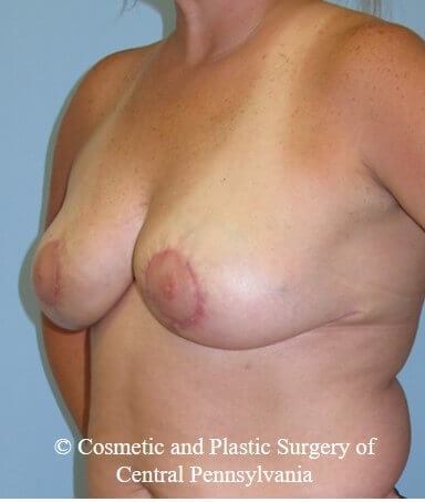 Breast Reduction After