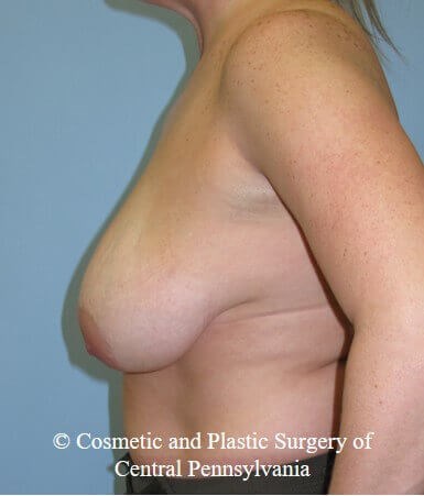 Braest Reduction Before