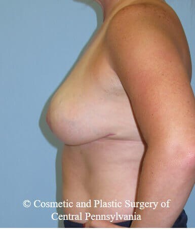 Braest Reduction After