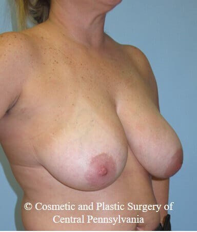 Breast Reduction Before