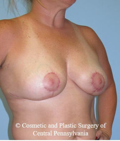 Breast Reduction After