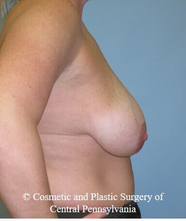 Breast Reduction Before