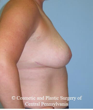 Breast Reduction After