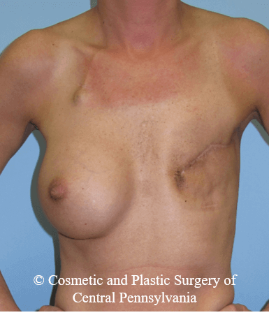 Breast Reconstruction Before