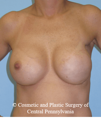 Breast Reconstruction After