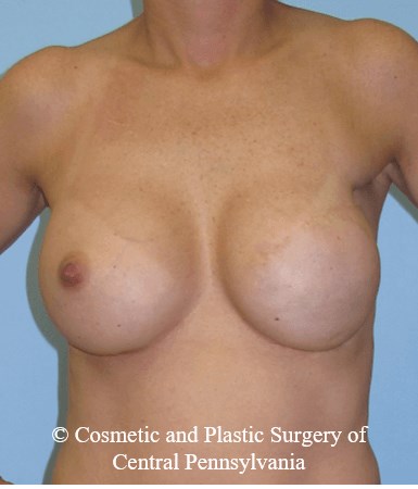 Breast Reconstruction After
