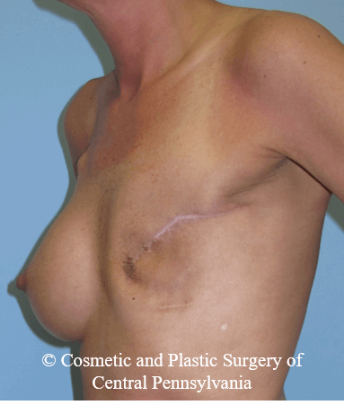 Breast Reconstruction Before