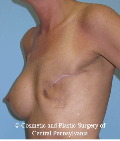 Breast Reconstruction Before