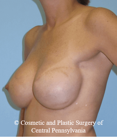 Breast Reconstruction After