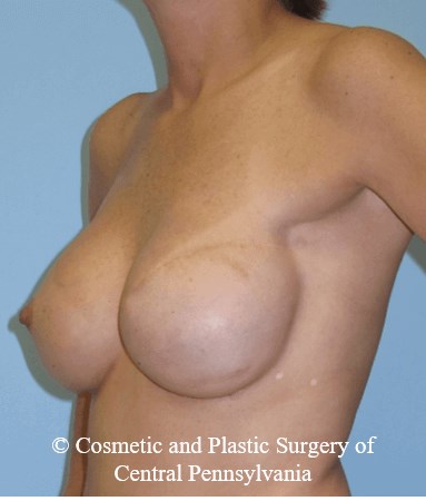 Breast Reconstruction After