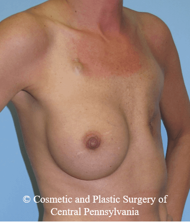 Breast Reconstruction Before