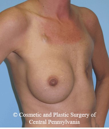 Breast Reconstruction Before