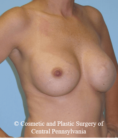 Breast Reconstruction After