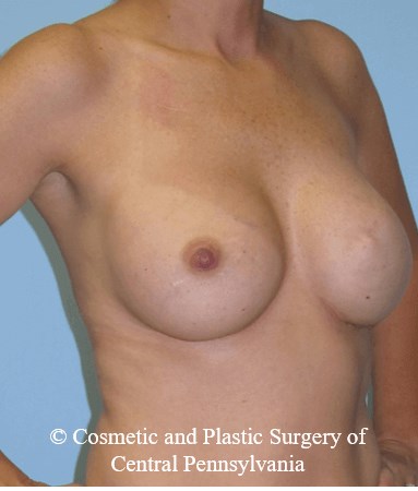 Breast Reconstruction After