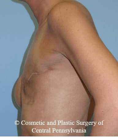 Breast Reconstruction Before