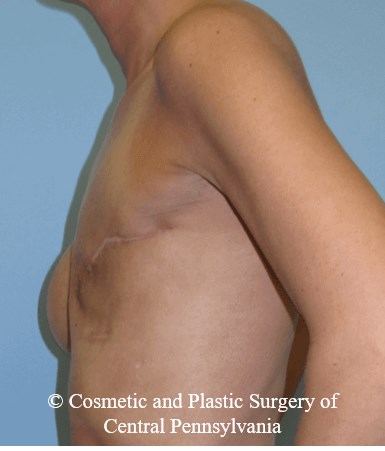 Breast Reconstruction Before