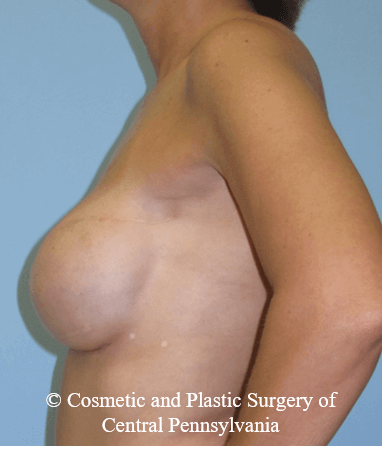 Breast Reconstruction After