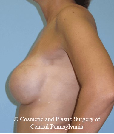 Breast Reconstruction After