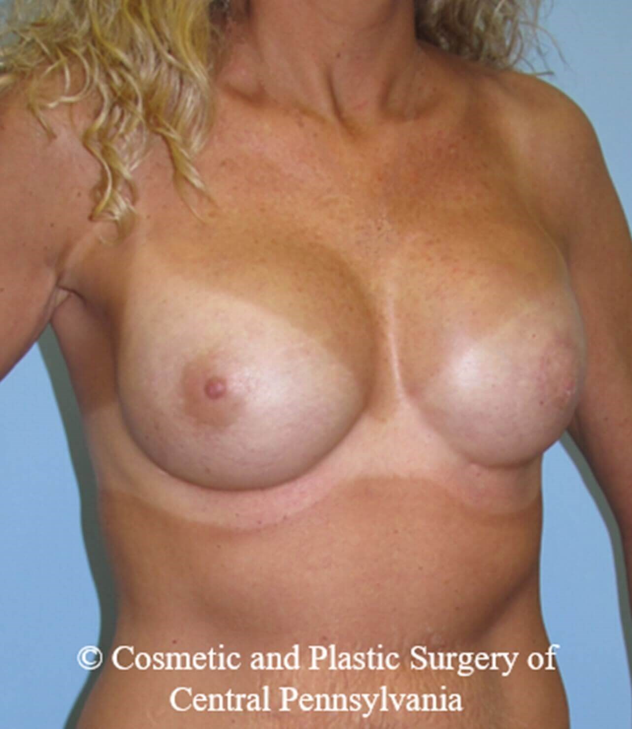 Breast Reconstruction After