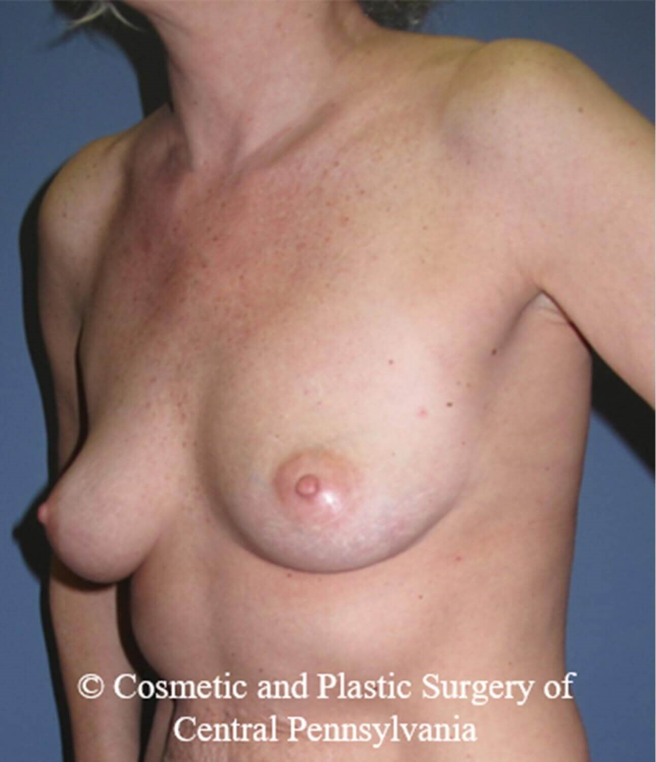 Breast Reconstruction Before