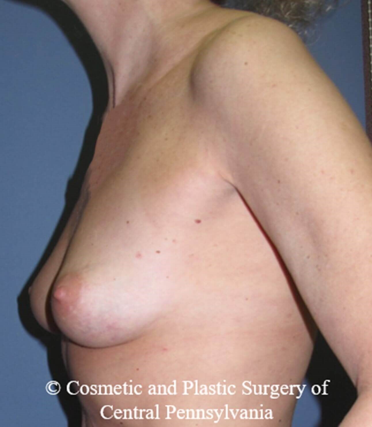 Breast Reconstruction Before