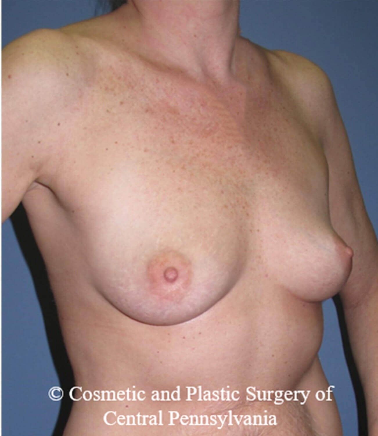 Breast Reconstruction Before