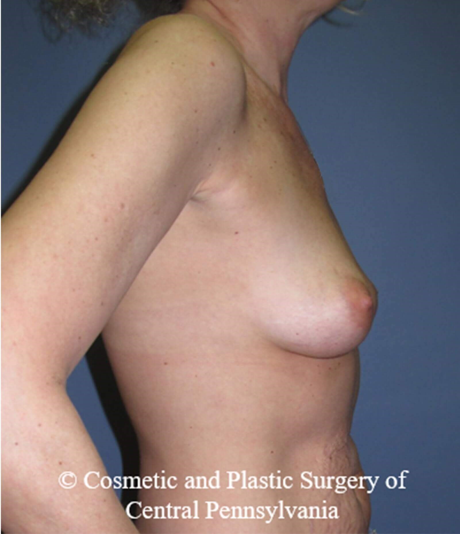 Breast Reconstruction Before