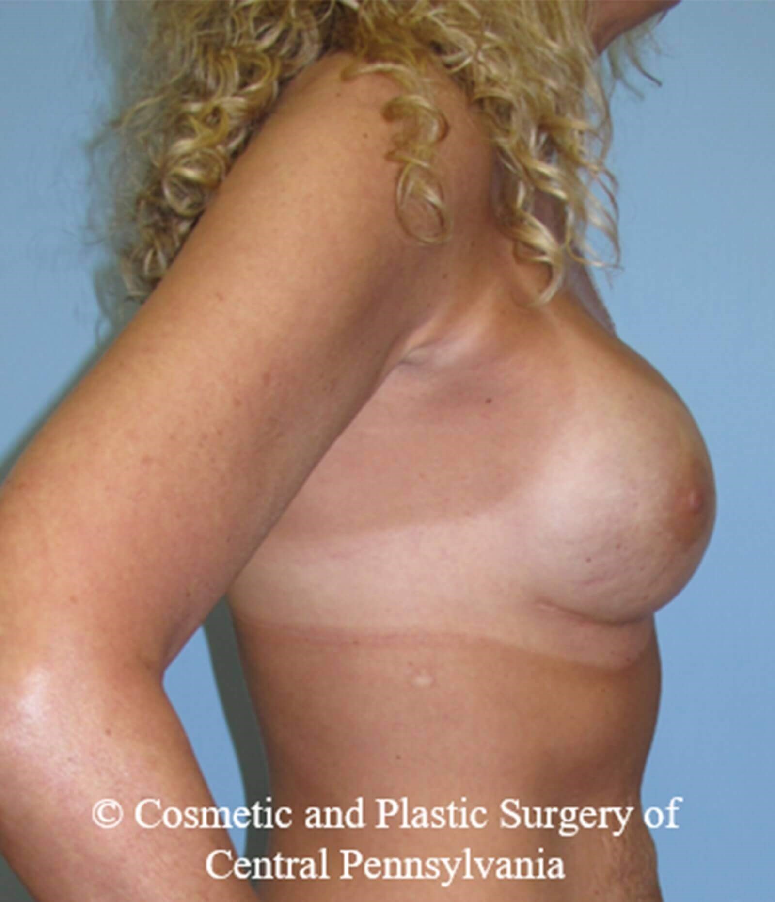 Breast Reconstruction After