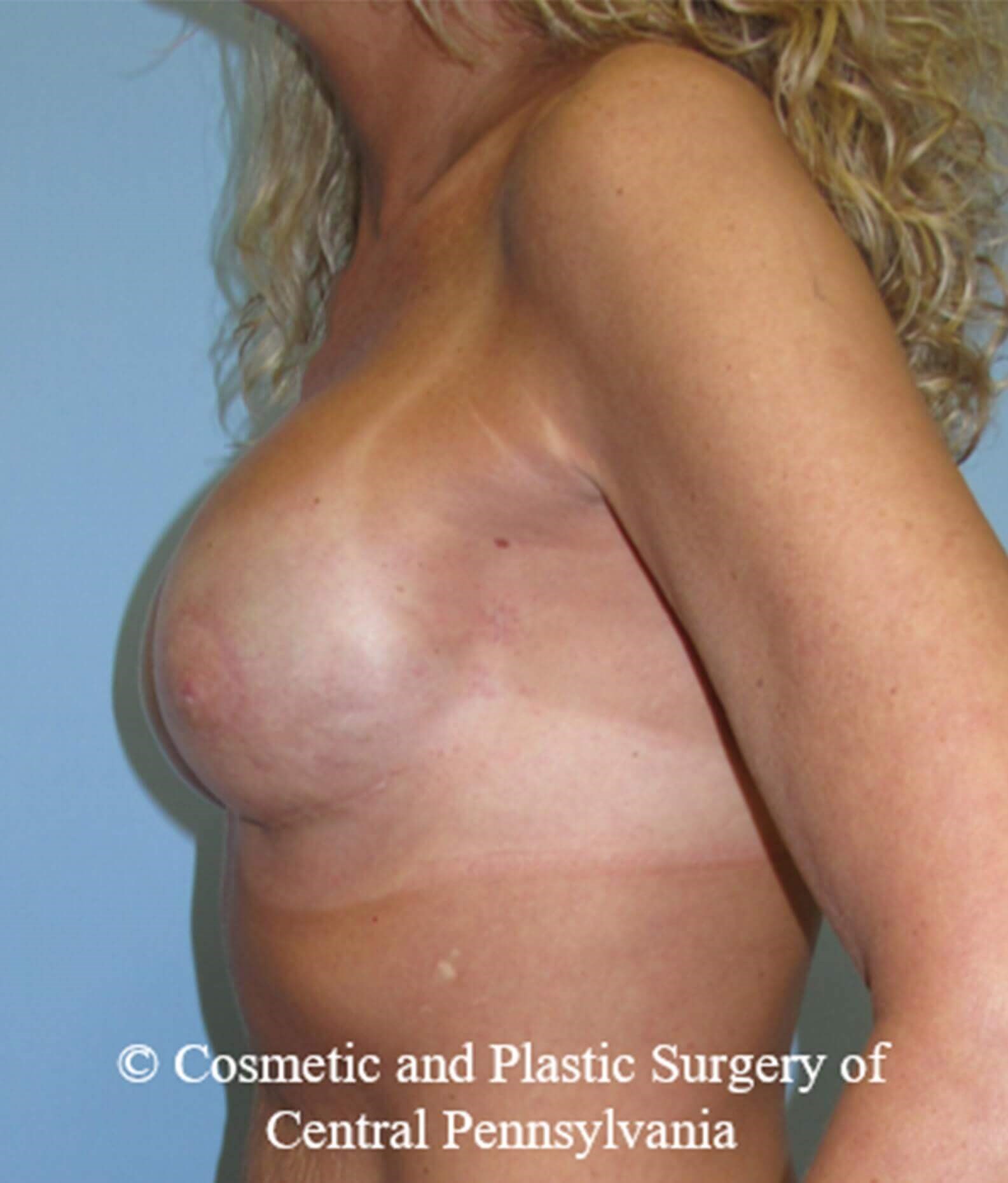 Breast Reconstruction After